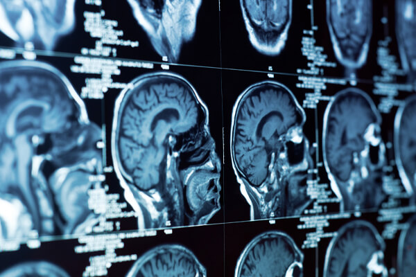 Hartford Connecticut Brain Injury Lawyer Hartford Connecticut TBI Head Injuries